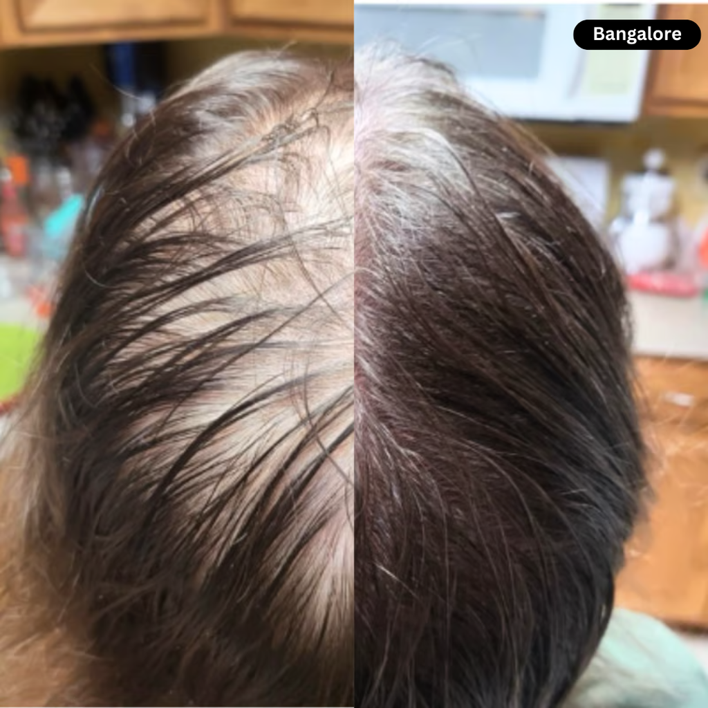 Hair Regrowth Red Light Therapy Hat